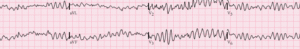 ventricular fibrillation