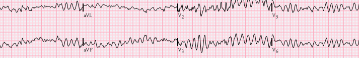 ventricular fibrillation